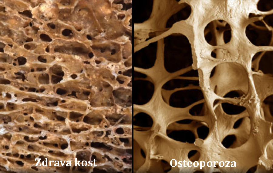 Zdrava kost i kost oboljela od osteoporoze