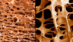 Zdravlje kostiju može se mjeriti njezinom gustoćom, kost zahvaćena osteoporozom znatno je slabija od zdrave kosti